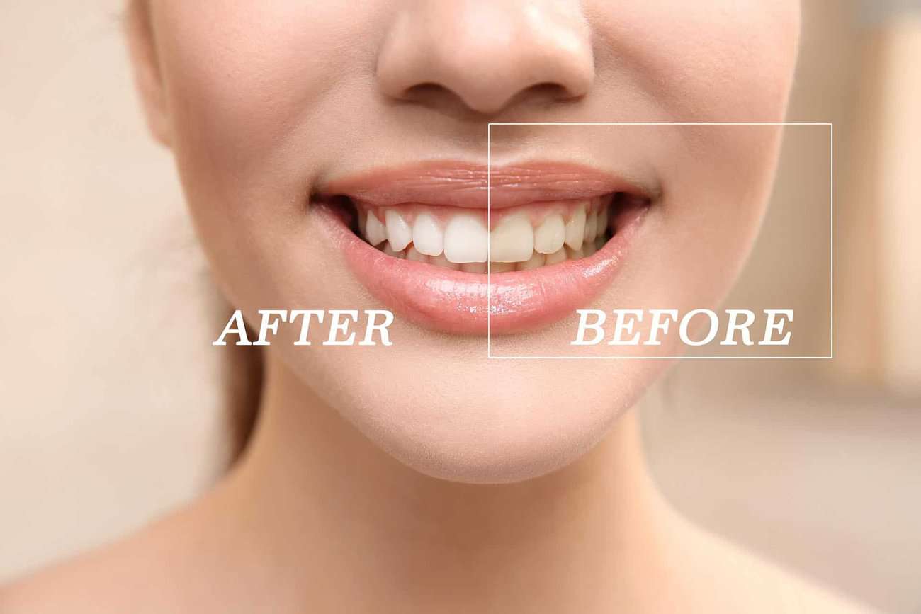 What Are the Most Effective Natural Teeth Whitening Methods You Can Try Maidstone?