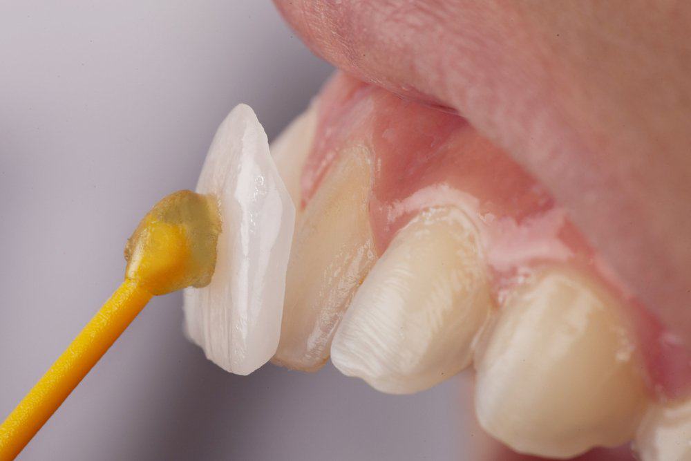 Dental Veneers: Achieving a Flawless Look Maidstone