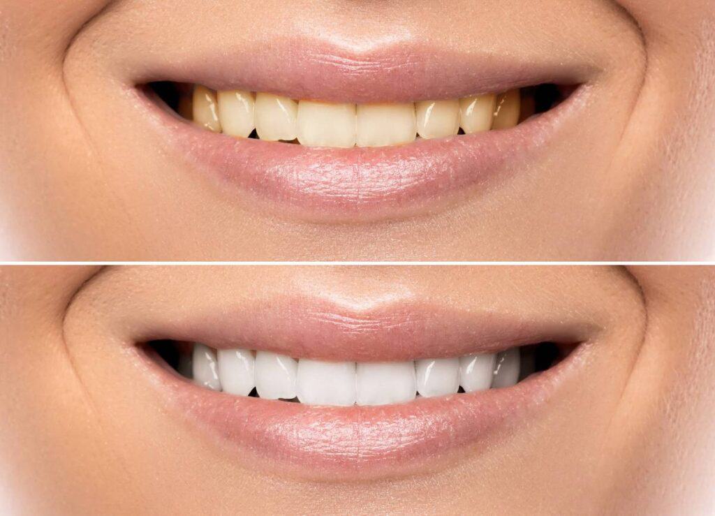 How Can You Protect Your White Smile as a Coffee Lover Maidstone?
