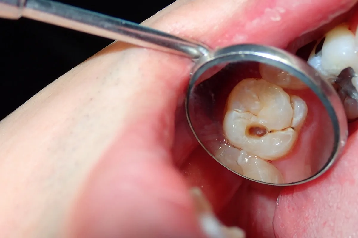 Why Do Teeth Crack? Common Causes to Know Maidstone