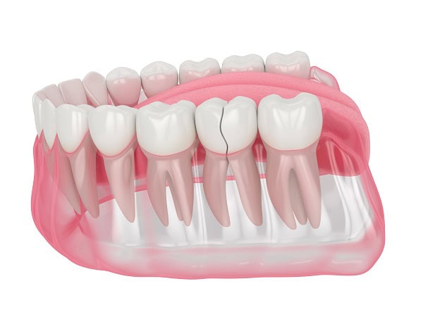 How Can You Manage Pain and Discomfort After a Root Canal Maidstone?