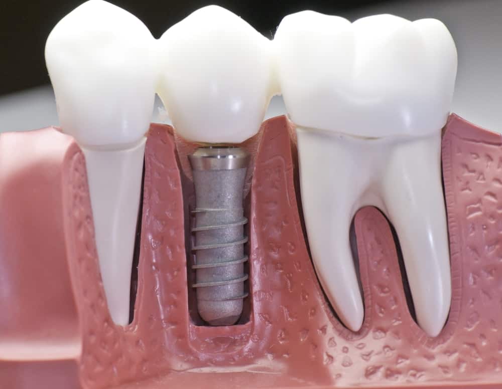 Who Is a Good Candidate for Dental Implants Maidstone?