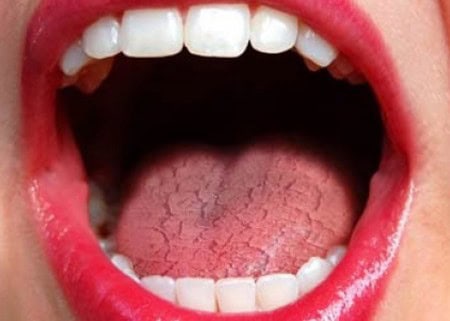 Dry Mouth and Its Role in Tooth Decay Maidstone