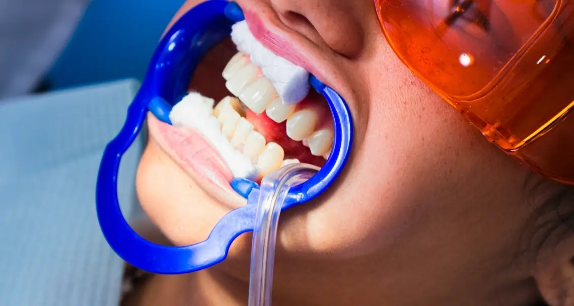 Is Laser Teeth Whitening Worth the Investment Maidstone?