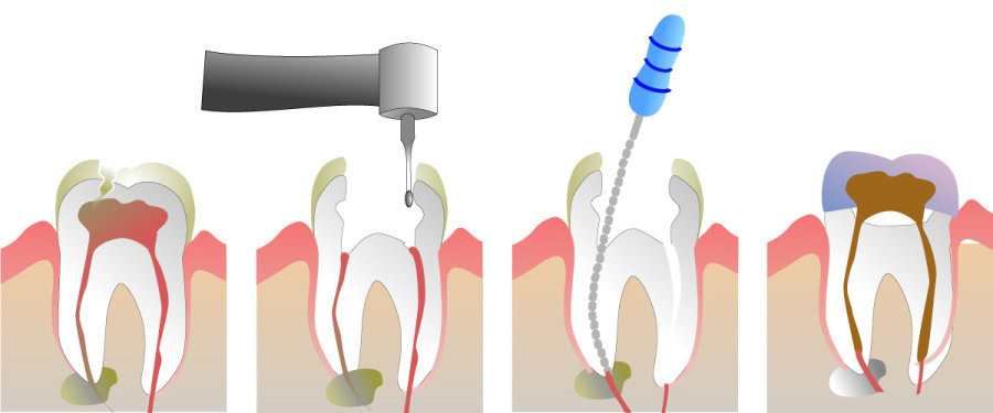 How Do You Properly Care for Your Teeth After a Root Canal Maidstone