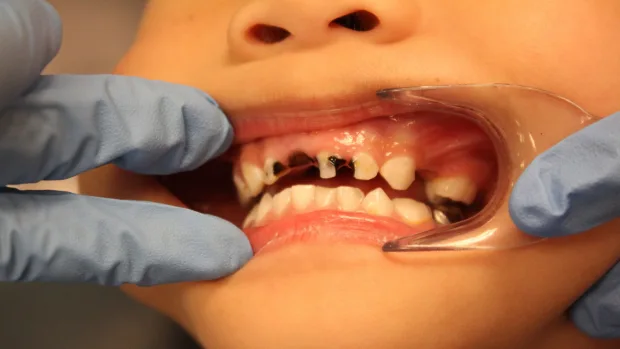 Which Foods and Drinks Cause the Most Damage to Young Smiles Maidstone?