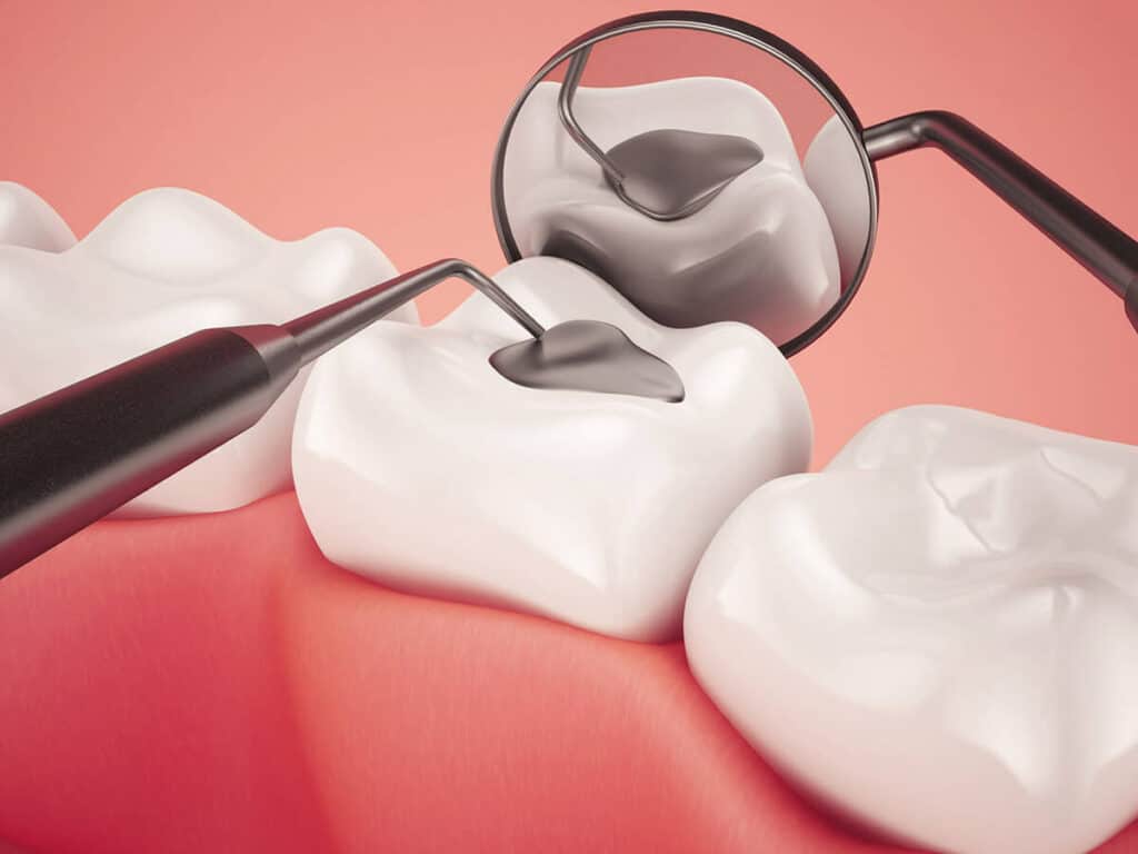 Fighting Cavities and Plaque Buildup Maidstone