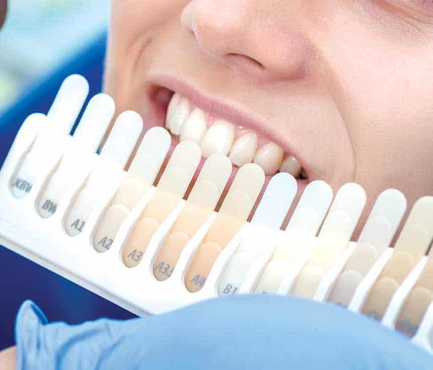 How Much Does One Laser Teeth Whitening Session Cost Maidstone?