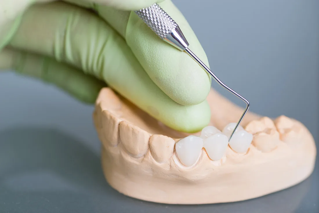Do Braces Take Years to Show Results Maidstone