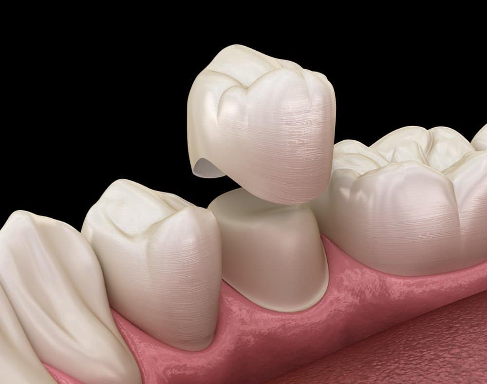 What is the Procedure for Getting Dental Implants Maidstone?