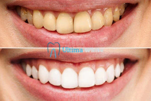 Why Might Multiple Whitening Sessions Be Necessary Maidstone?