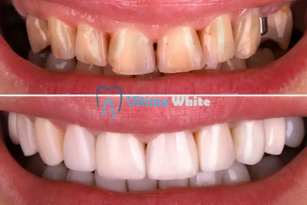 What Makes Instant Teeth Whitening Treatments So Popular Maidstone?