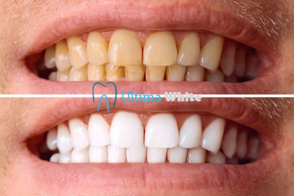 Stained Teeth and Persistent Bad Breath Maidstone